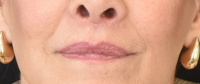 Lip Lift Patient 14 Set 1 After